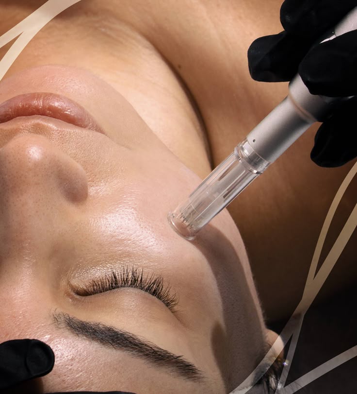 Microneedling Microneedling