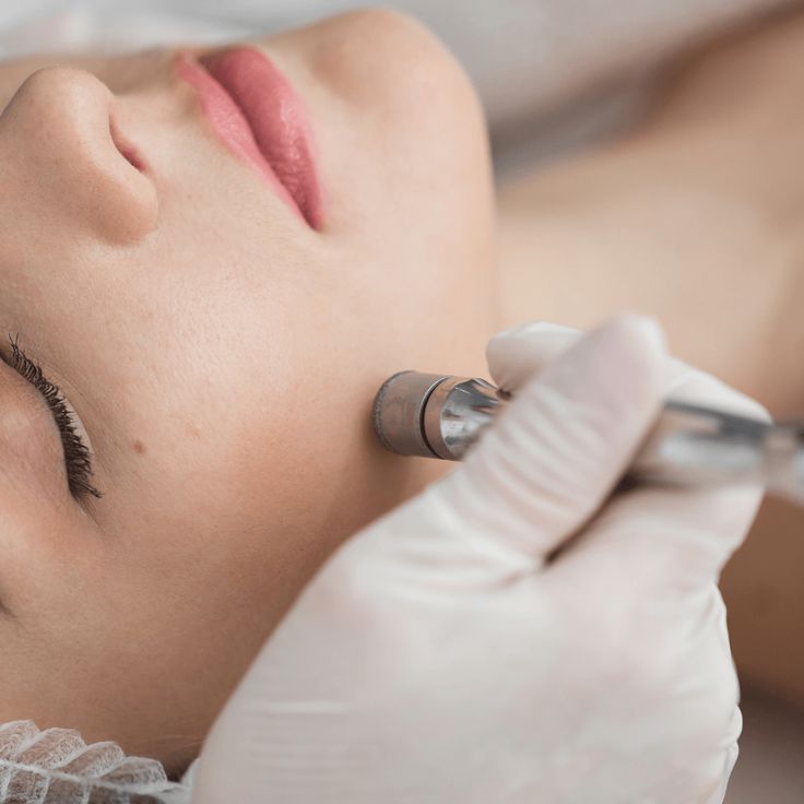 Microdermabrasion Microdermabrasion